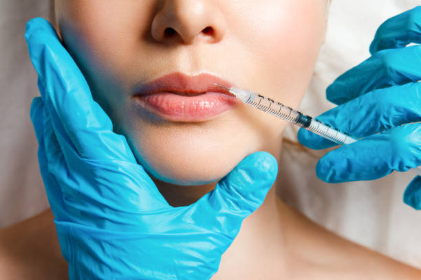LIPS: Mini Lip Plump (1/2 syringe filler) + FREE stimulator peel OR lip flip